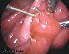 Fimbrioplasty (laparoscopic image).